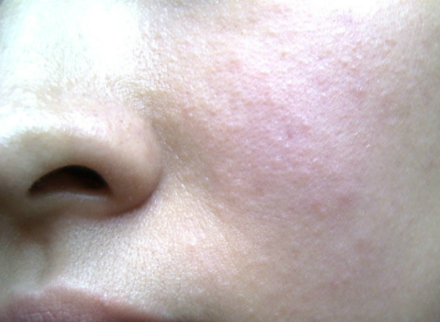 珍妮肤护肤小技巧:脸部皮肤过敏如何护理?